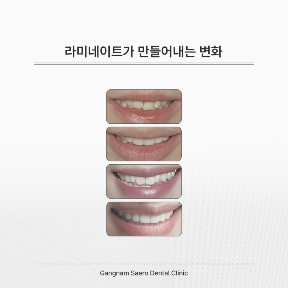 Completing Natural Beauty with No-Prep Laminate Veneers (Airnate) image 2