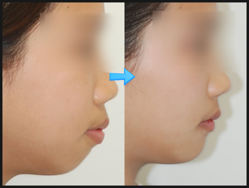 비발치로 뻐드렁니교정을 진행할 수 있다? 관련 이미지 9