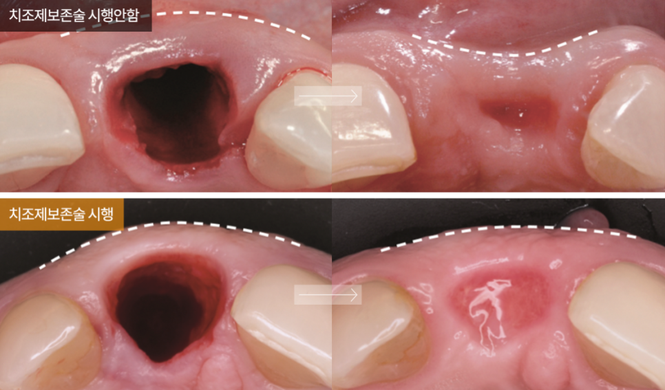 임플란트 부작용 총정리 [ 임플란트 전후 주의사항 ] [ 강남새로치과 ] 관련 이미지 6