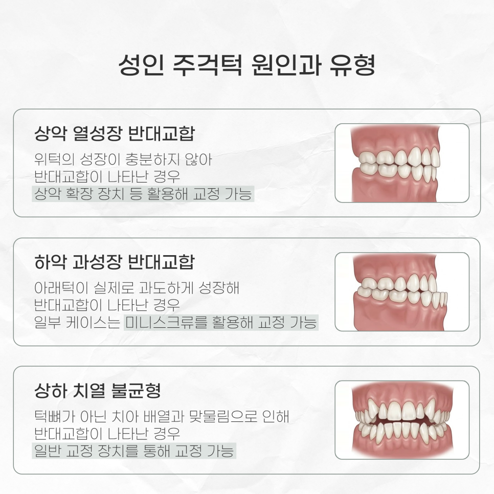 주걱턱 수술 없이 교정하려면 아직 늦지 않은 선택 (성인 비수술주걱턱) 관련 이미지 2