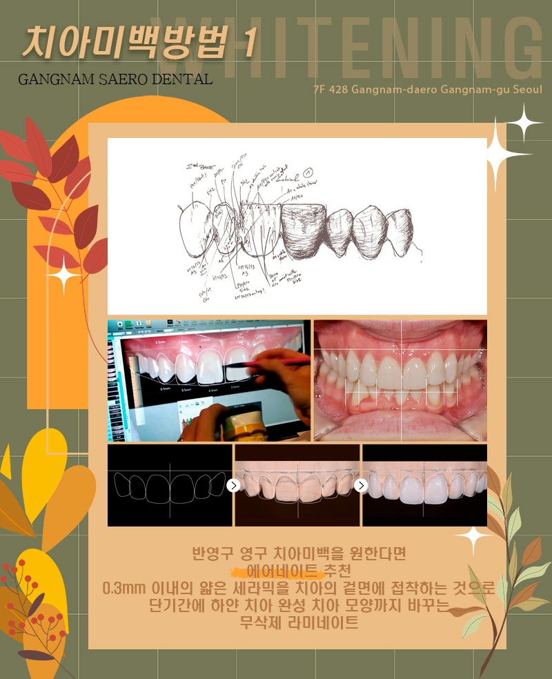 치아미백방법 치아미백비교 치아미백전후 (에어네이트, 전문가미백, 자가미백) 관련 이미지 2