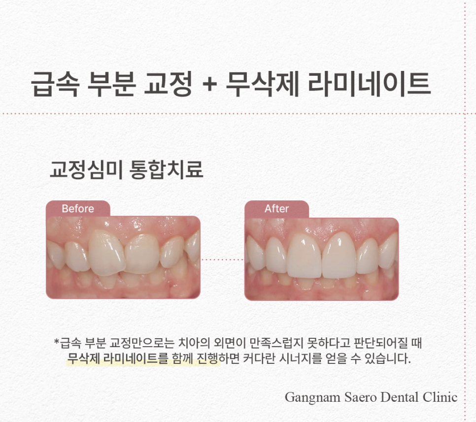 치아 일부만 교정하고 싶다면 비용과 시간을 절약하는 (급속부분교정) 관련 이미지 9