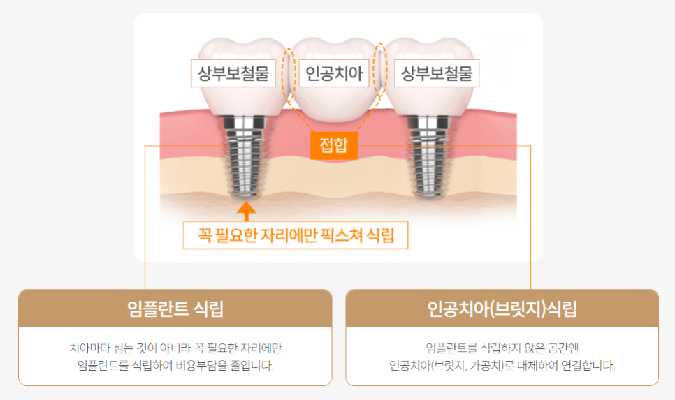 최소식립 65세 70대 임플란트 (전체임플란트) 관련 이미지 5
