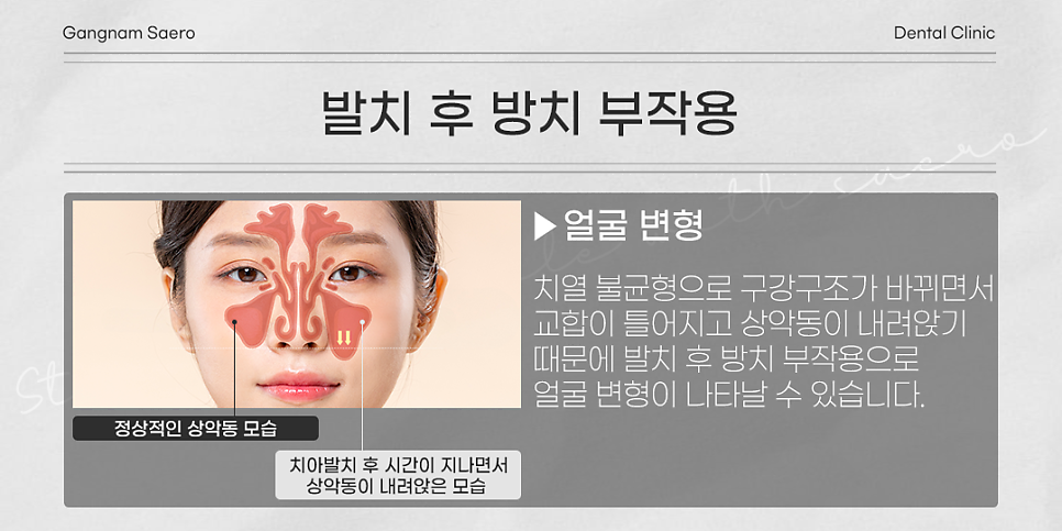 발치 후 꼭 임플란트 해야 하나요? (임플란트안하면) 관련 이미지 5