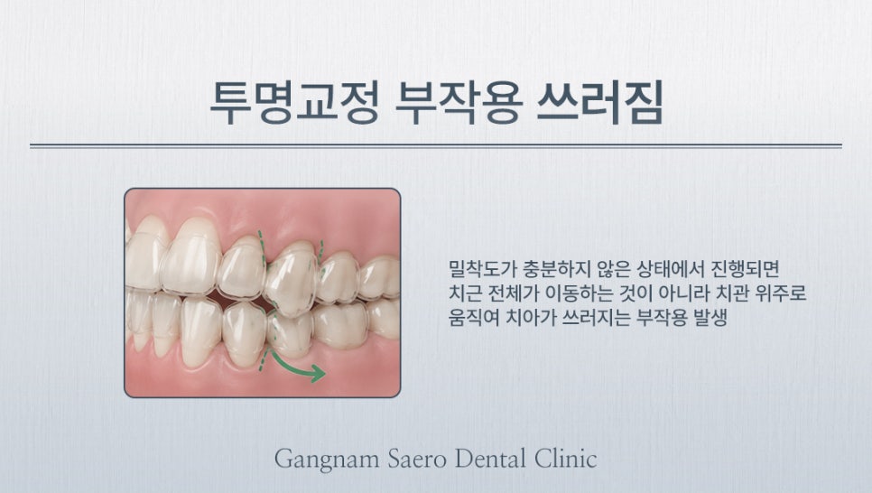 투명교정 시작 전 꼭 알아야 할 한계와 보완 방법 (투명교정부작용) 관련 이미지 4