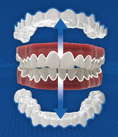 투명교정장치 다시 알아보기 (4) 세라핀 관련 이미지 1