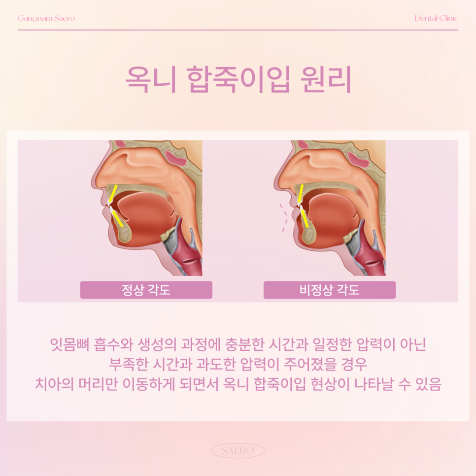 교정얼굴변화 부작용 안내 (옥니, 팔자주름, 인중 길어짐 등) 관련 이미지 3