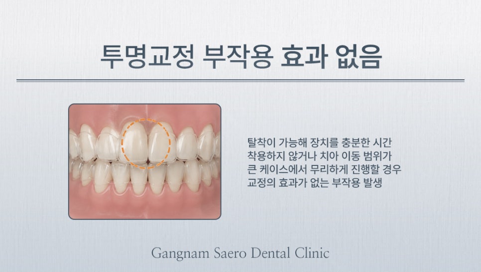 투명교정 시작 전 꼭 알아야 할 한계와 보완 방법 (투명교정부작용) 관련 이미지 5