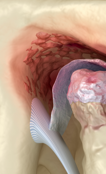 턱관절 탈구가 발생하는 원인과 치료 방법? 관련 이미지 5