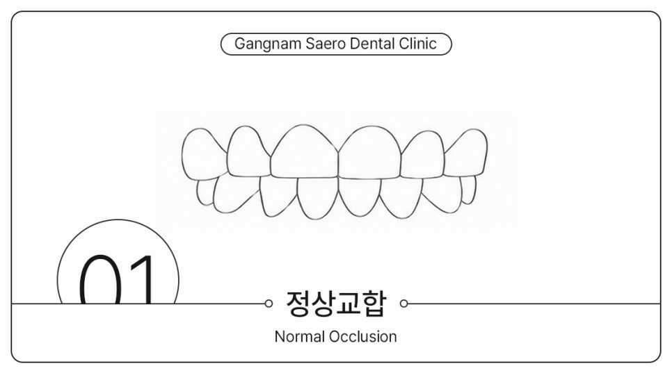 부정교합 개방교합 과개교합 투명교정으로 가능할까요? (주걱턱교정기 돌출입교정기) 관련 이미지 3