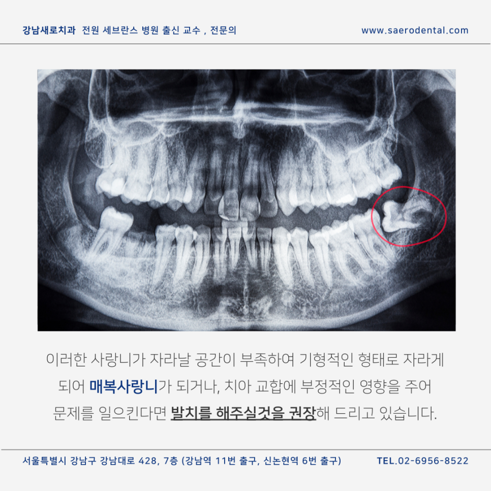 강남사랑니치과, 매복사랑니를 더욱 효율적으로 발치하려면 관련 이미지 2