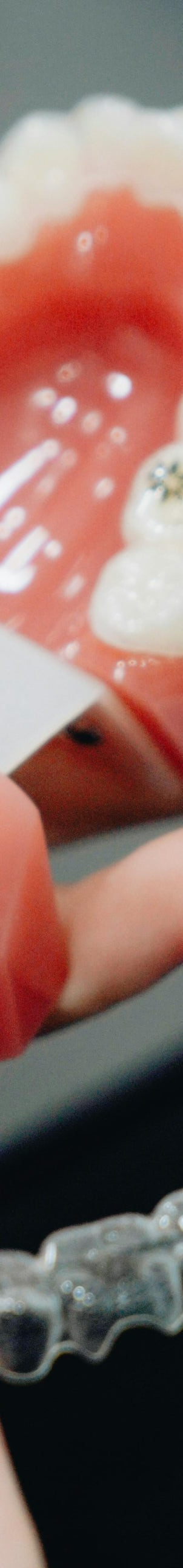 치아 교정이 궁금해? 치료가 좋은 결과로 이어지려면 관련 이미지 11