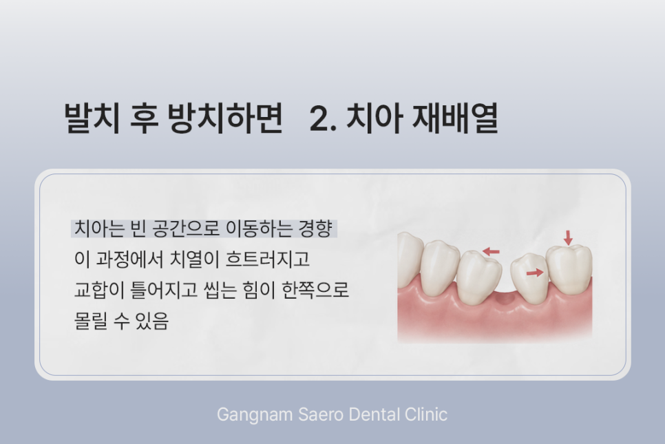 What Happens If You Do Not Get an Implant After Tooth Extraction? (Implants After Tooth Extraction) image 4