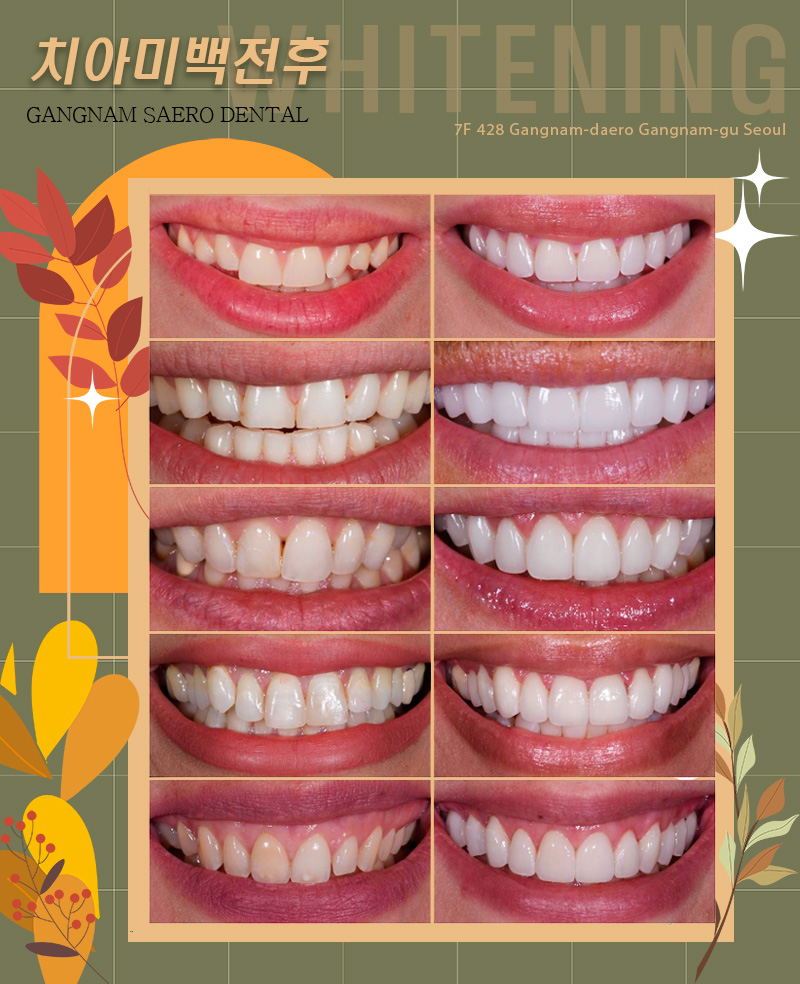 치아미백방법 치아미백비교 치아미백전후 (에어네이트, 전문가미백, 자가미백) 관련 이미지 6