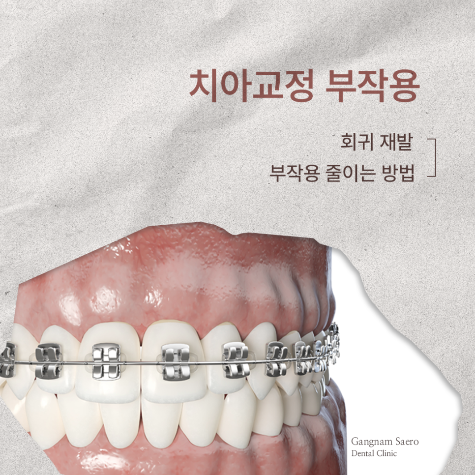 Orthodontic Side Effects (Relapse and Recurrence): Ways to Reduce Side Effects image 4