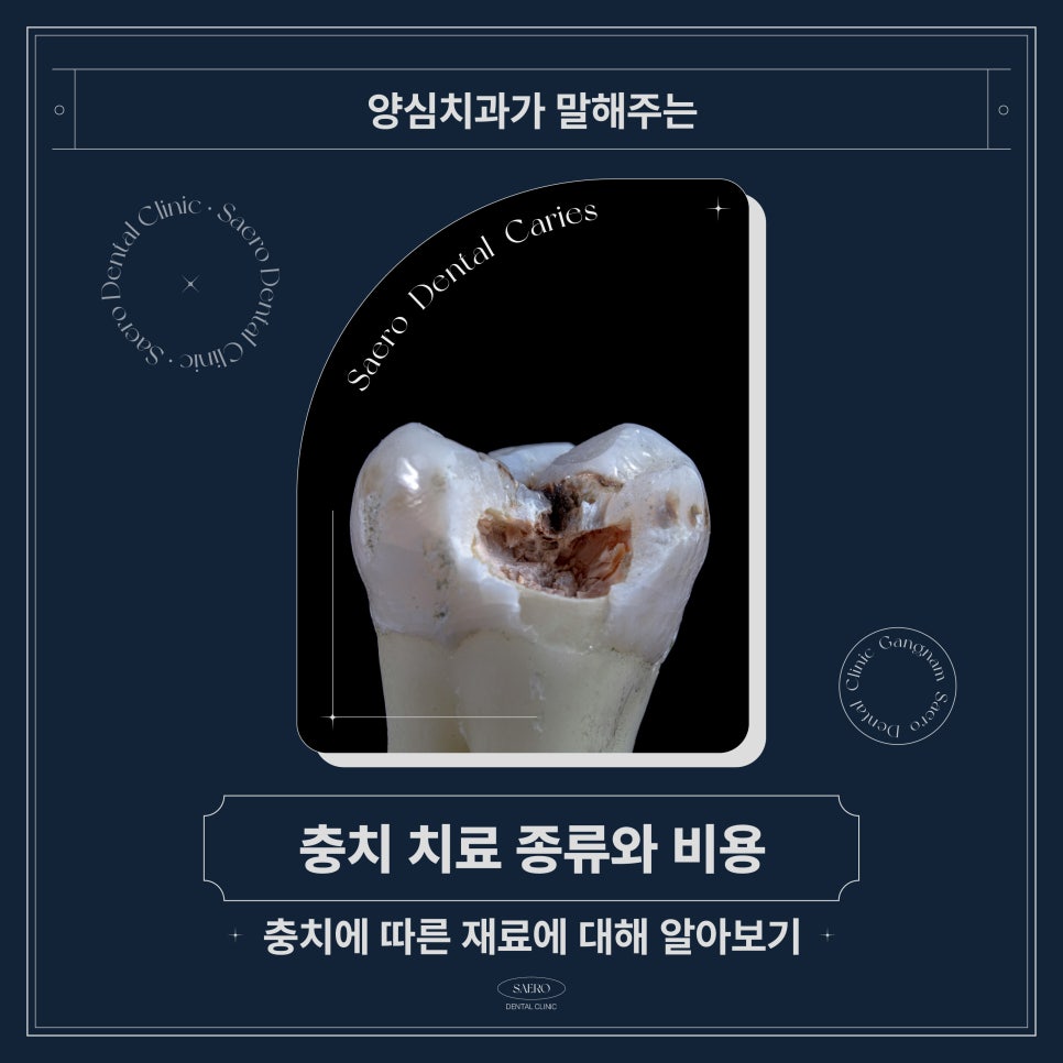 충치치료방법 레진, 인레이/온레이, 크라운 차이 (충치치료비용) 관련 이미지 1