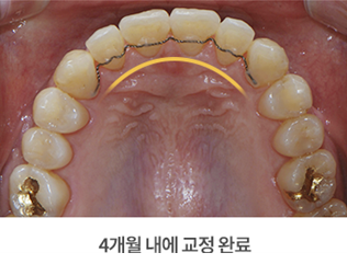 4개월 급속교정 (전체교정은 부담스럽다면 부분교정) [ 강남새로치과 ] 관련 이미지 6