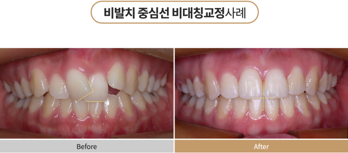 비발치로 뻐드렁니교정을 진행할 수 있다? 관련 이미지 5
