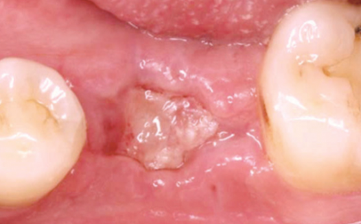 임플란트 안전한 결과를 위하여 [ 상악동거상술 ] [ 강남새로치과 ] 관련 이미지 11