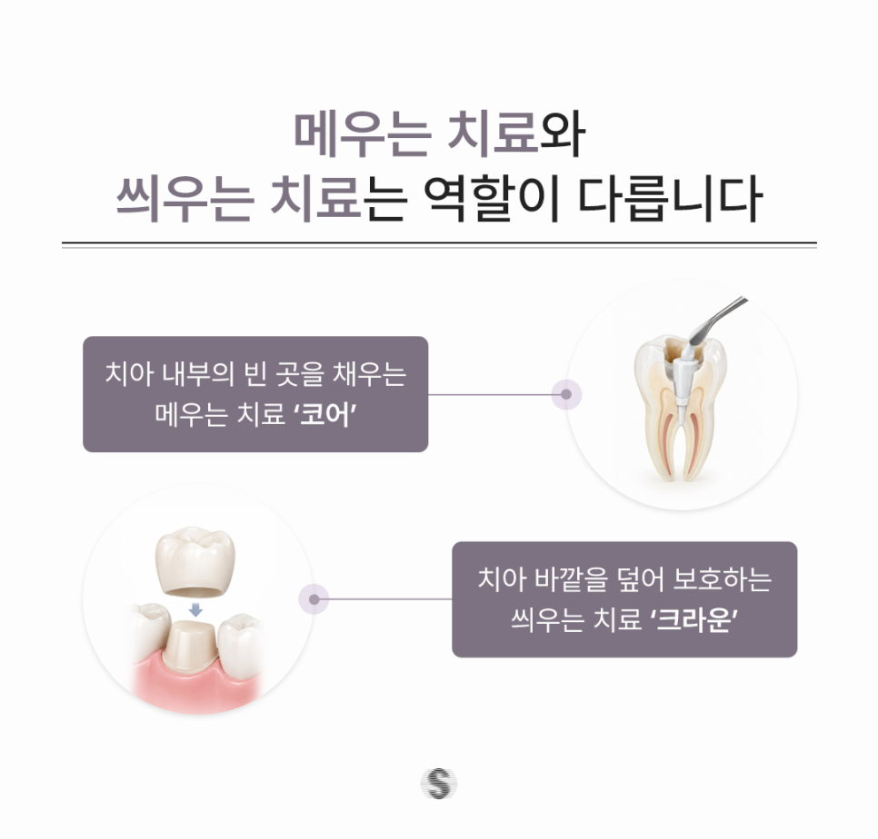 치아크라운, 신경치료 후 꼭 해야 하나요? 종류와 선택 방법까지 관련 이미지 3