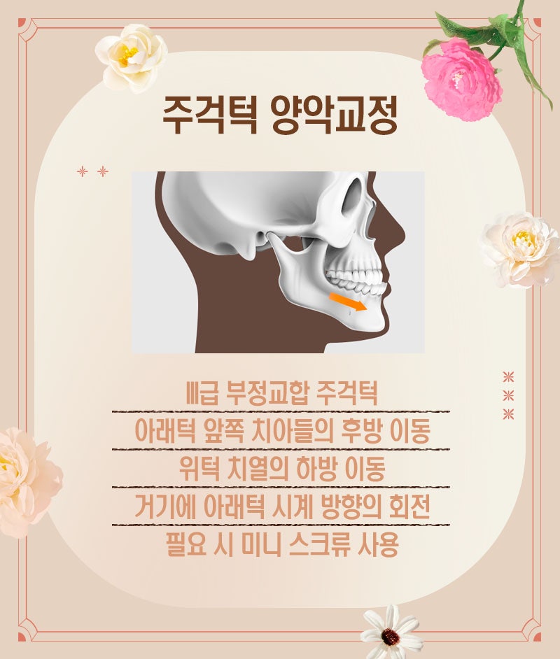 교정으로 얼굴형 변화시킬 수 있다?! (유형별 양악교정 안내) 관련 이미지 4