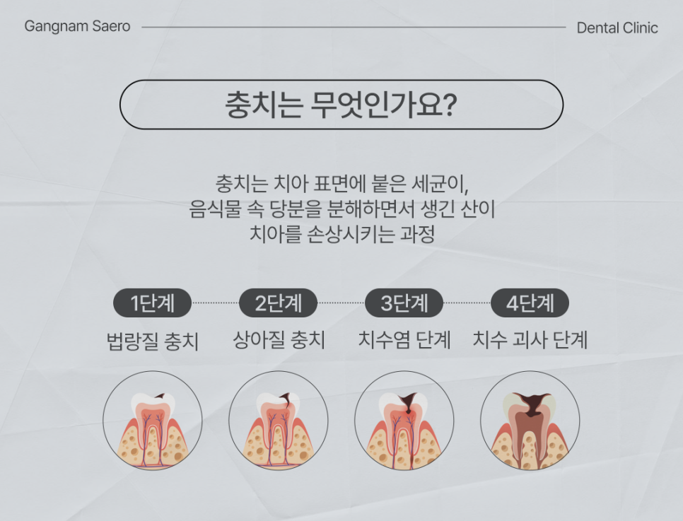 Is There a Cavity That Doesn’t Need Treatment? (Arrested Caries) image 2