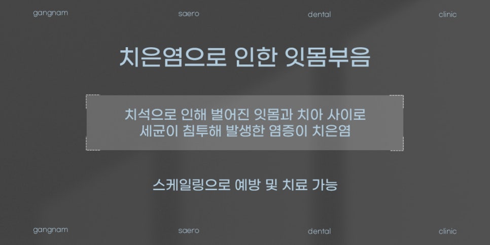 갑자기 잇몸이 부었다면? (잇몸부음원인 잇몸부음해결) 관련 이미지 3