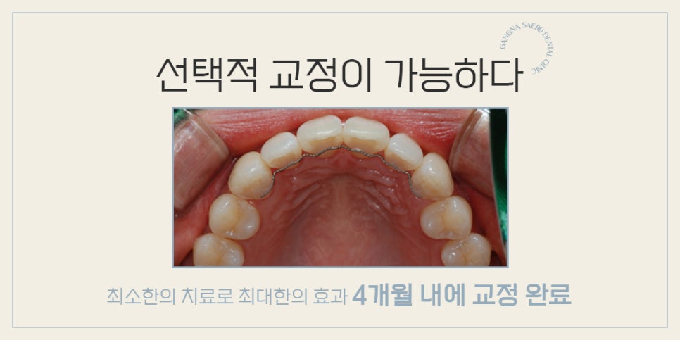4개월이면 치료 종료되는 급속교정 (강남역부분교정) 관련 이미지 8