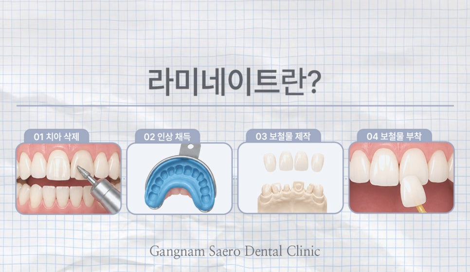 치아 컴플렉스 해결에는 삭제제로라미네이트 에어네이트 (무삭제라미네이트) 관련 이미지 2
