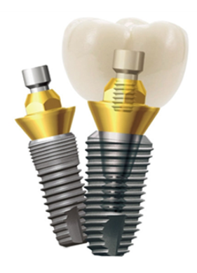 임플란트회사 임플란트종류 임플란트브랜드 (4) 덴티움 관련 이미지 2