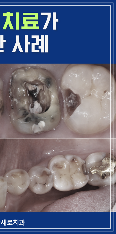 탕후루 치아 손상을 유발? 치료 방법 및 후기 관련 이미지 11