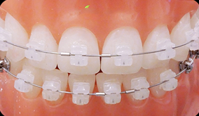 클리피씨가 뭔가요? 데이몬 클리어는 뭔가요? (자가결찰교정종류) 관련 이미지 4