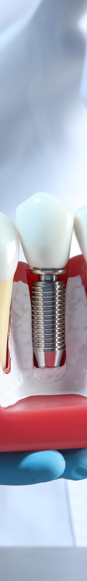 임플란트 치료, 보철물 수명, 교체 시기, 구강을 위해 알아둡시다. 관련 이미지 9