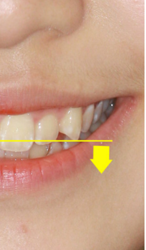 송곳니 덧니 교정없이 방치하면 발생하는 문제? 관련 이미지 7