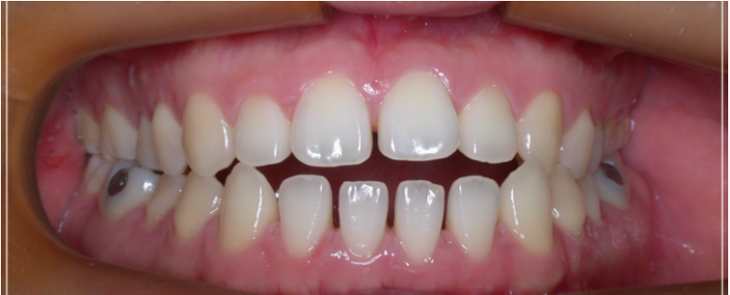 입 안 다물어짐 수술 없이 해결하는 방법 관련 이미지 11