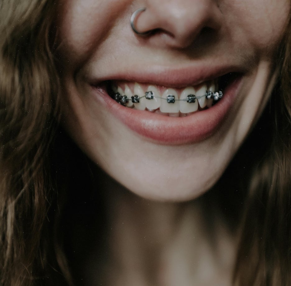 성인치아교정 치료, 부정교합, 구강 건강 개선이 될까요? 고민하고 계시다면 궁금증 타파해드립니다! 관련 이미지 1