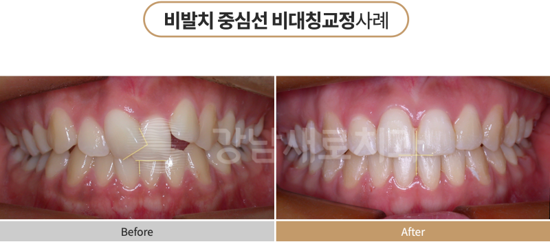 강남역교정치과를 찾고 계신다면? 비발치로 해결하세요! 관련 이미지 4