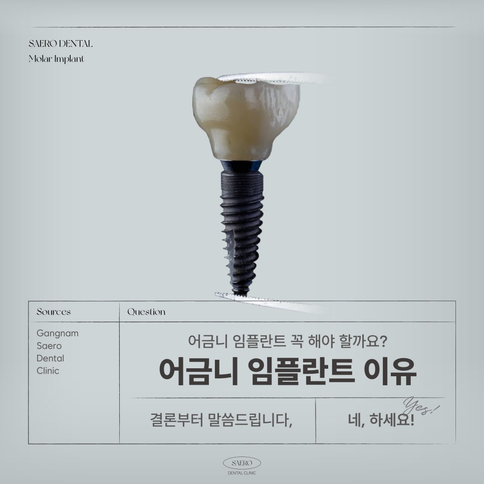 (어금니임플란트) 어금니 발치 후 임플란트 해야 하는 이유 관련 이미지 1