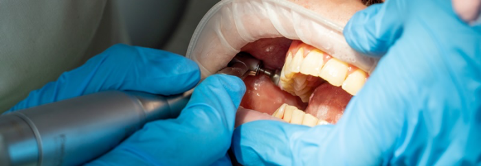 잇몸내려앉음이 발생하는 원인을 제대로 알아야 관련 이미지 8