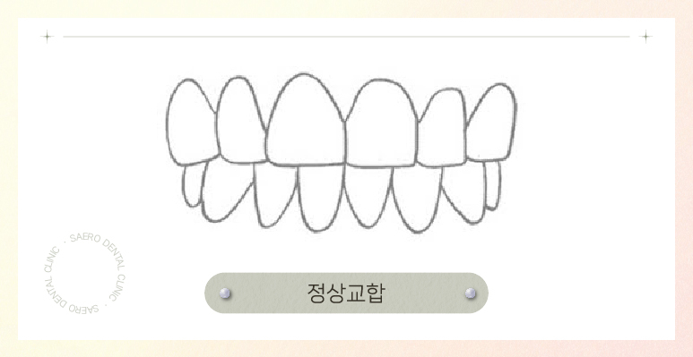 부정교합 투명교정 (1~3급 부정교합 개방교합 과개교합 인비절라인 나노라이너) [ 강남새로치과 ] 관련 이미지 3