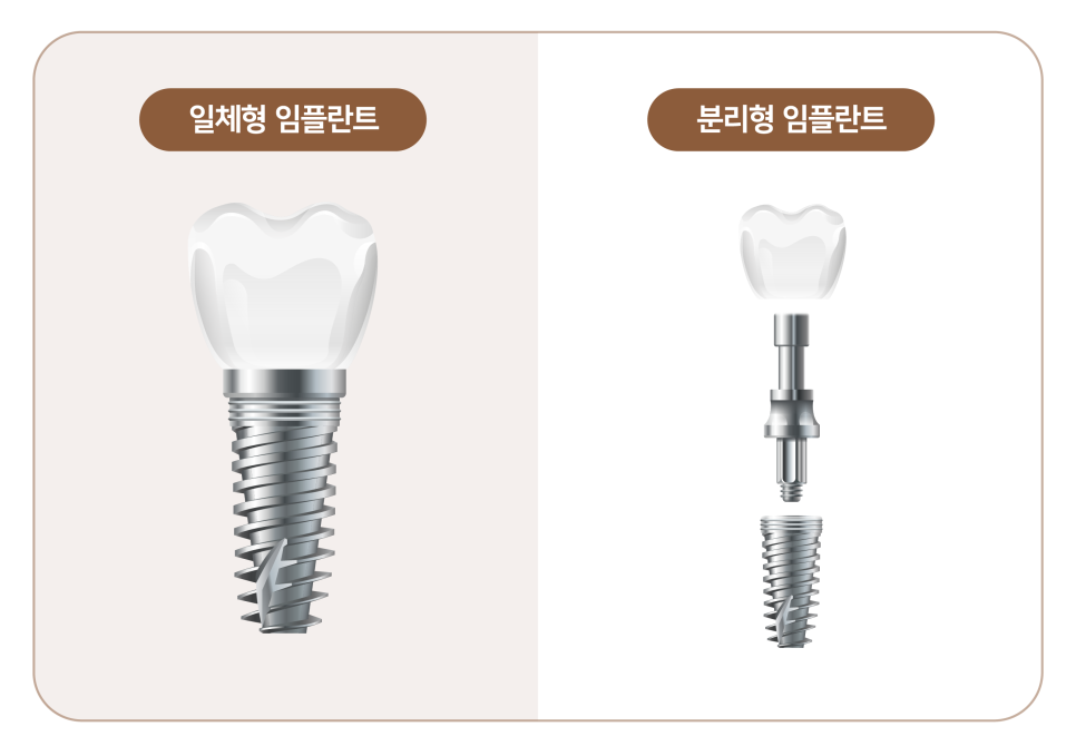 임플란트부작용 보철 (크라운, 지대주, 픽스쳐) 예방 및 대처 방법 관련 이미지 2