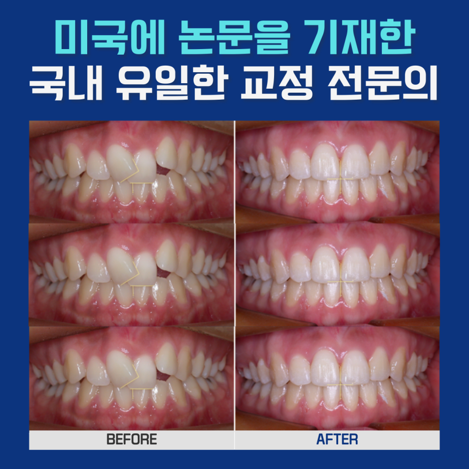 부정교합 교정치료, 발치 없이 단기간에 치료할 수 있다? 관련 이미지 5
