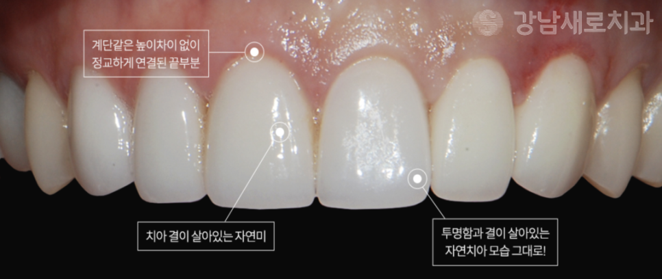 연예인라미네이트, 강남새로치과만의 특별한 방법? 관련 이미지 7