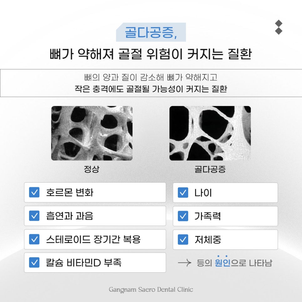 골다공증 있으면 임플란트 못 하나요? 골다공증 원인과 증상 관련 이미지 2
