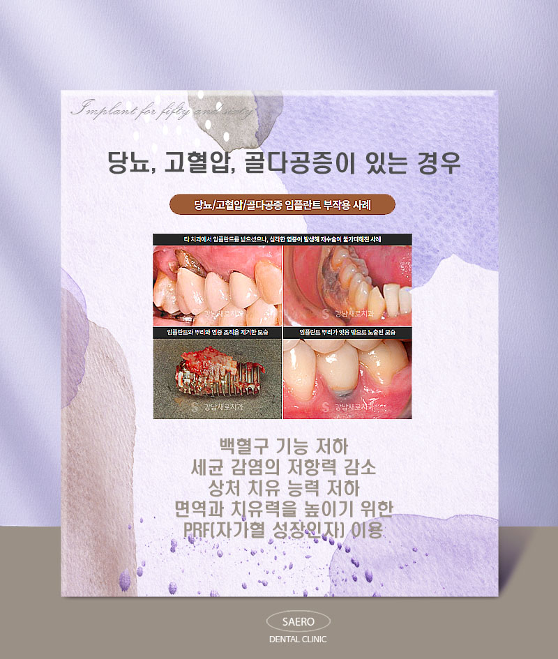 부모님세대 5060을 위한 임플란트 (상악동거상, 당뇨, 고혈압, 골다공증, 무치악 임플란트) 관련 이미지 5