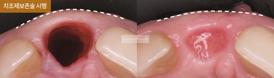 임플란트 부작용 자세히 알아보기(3) 임플란트 치주조직손상 부작용 [ 예방 및 대처 방법 ] [ 강남새로치과 ] 관련 이미지 6