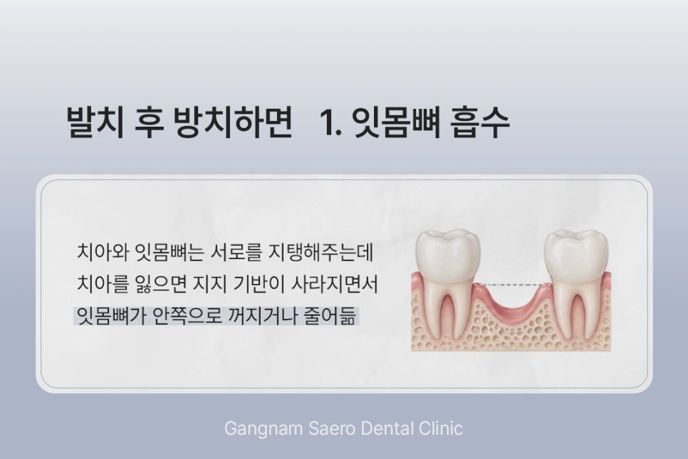 What Happens If You Do Not Get an Implant After Tooth Extraction? (Implants After Tooth Extraction) image 3