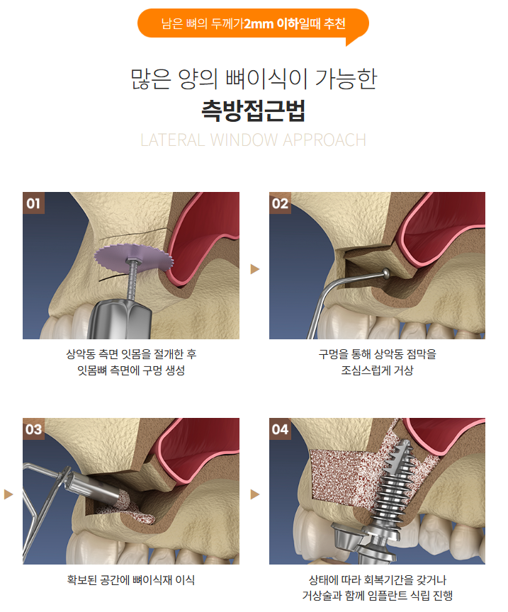 윗니 임플란트 안정성 높이는 강남새로치과 핵심 술식 （상악동거상술） 관련 이미지 4