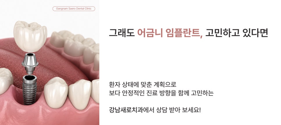 어금니 발치 후 임플란트 안 하면 어떻게 될까요? (어금니임플란트) 관련 이미지 7