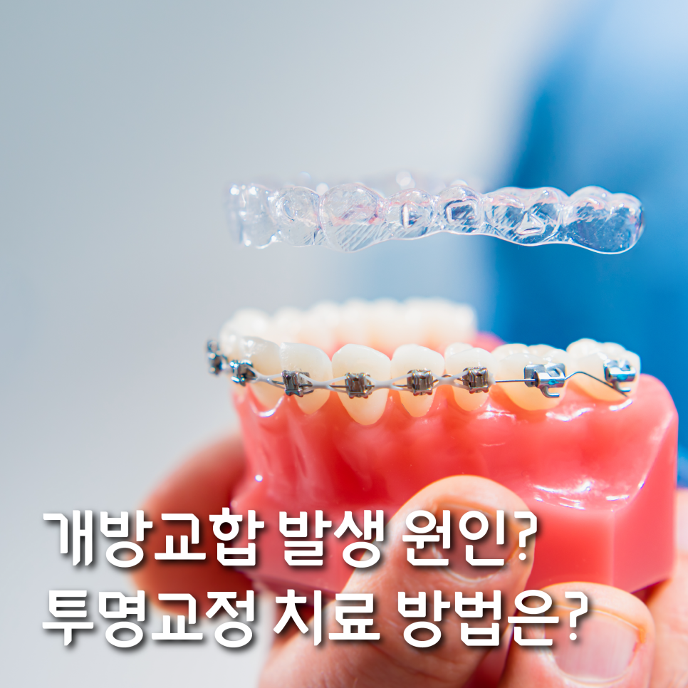 개방교합 발생 원인과 투명교정을 통한 치료 방법은? 관련 이미지 1